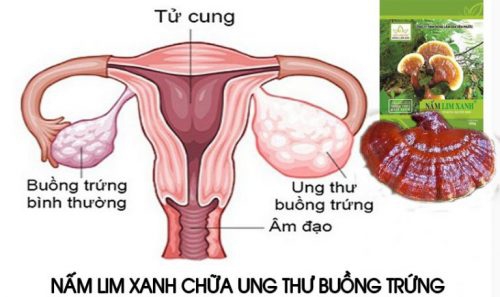 Nấm lim xanh chữa ung thư buồng trứng là thật hay chỉ là quảng cáo?